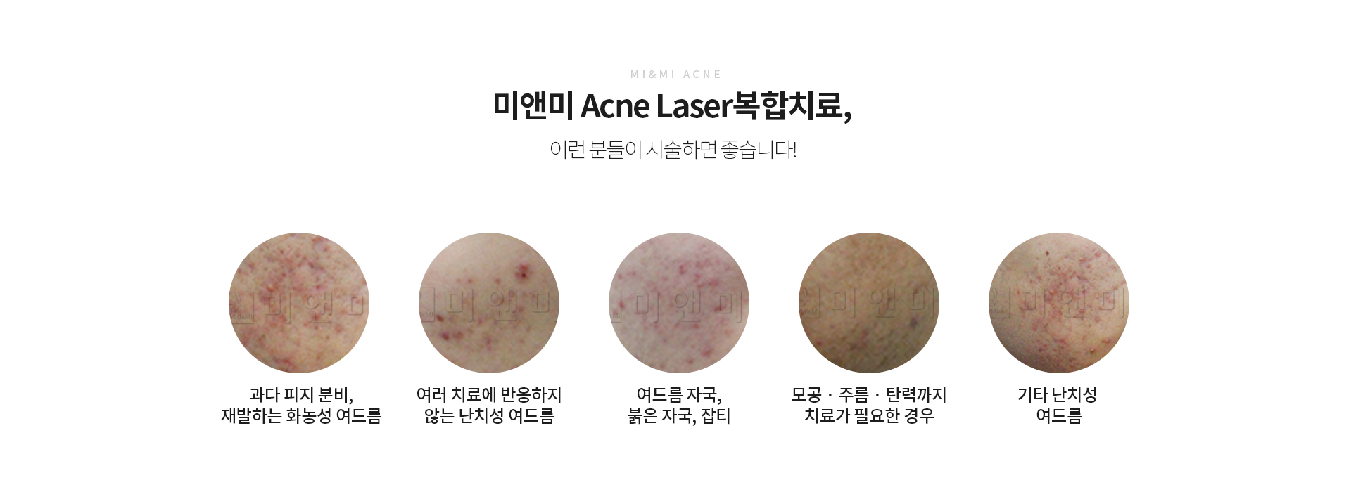 여드름 종류