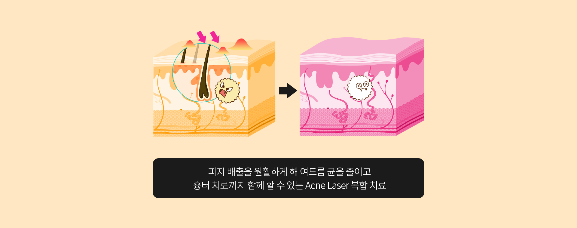 여드름 조직