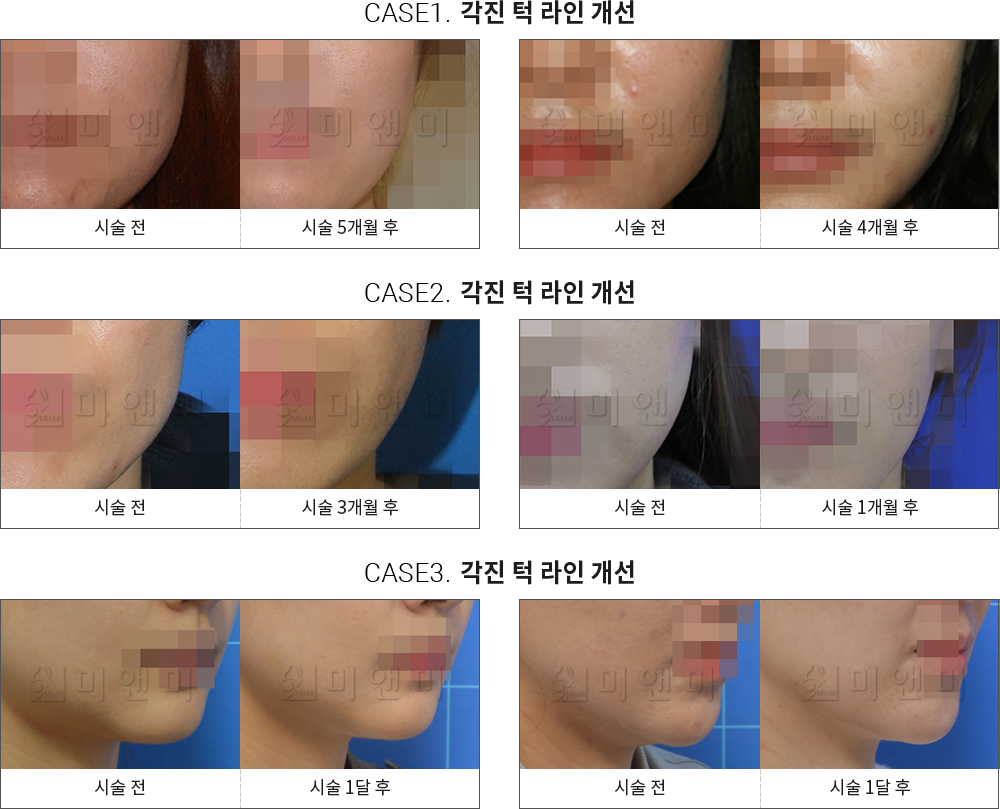 시술전후사진 사각턱 보톡스 : 각진 턱 라인 개선 사각턱보톡스란? - 미앤미 의원