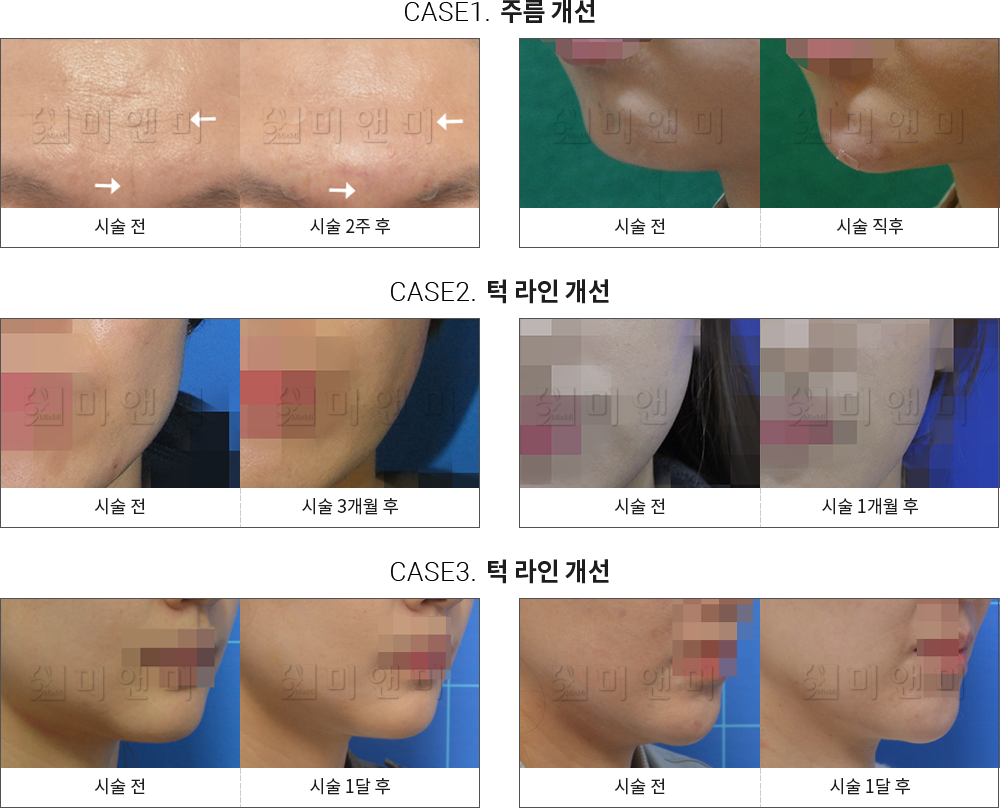 시술전후사진 주름 보톡스 : 주름 개선, 턱 라인 개선 주름보톡스란? - 미앤미 의원