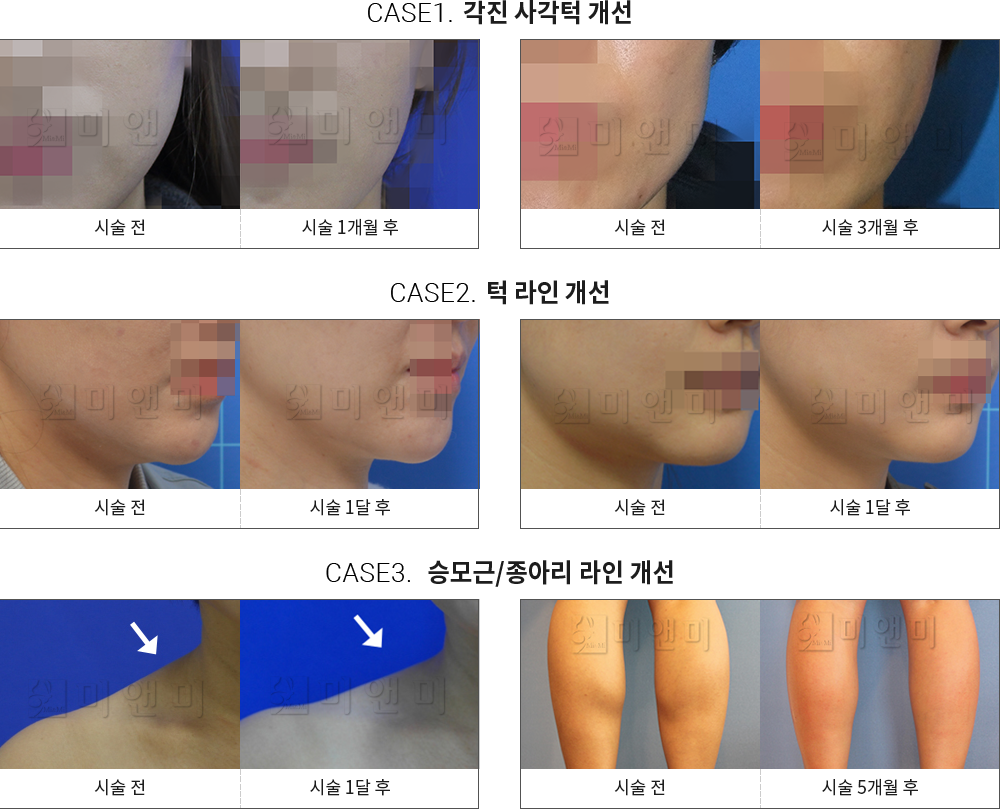 시술전후사진 승모근 보톡스 : 각진 사각턱 개선,턱 라인 개선,승모근/종아리 라인 개선 승모근보톡스