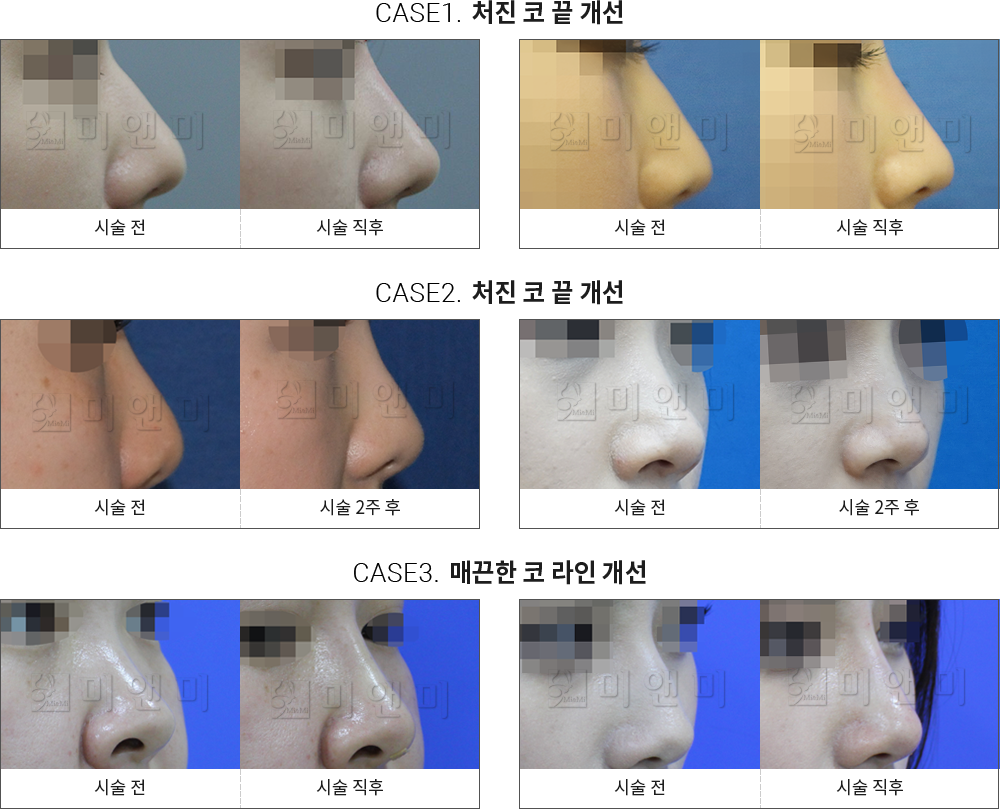 시술전후사진 미앤코 : 처진 코 끝 개선, 매끈한 코라인 개선 미앤코