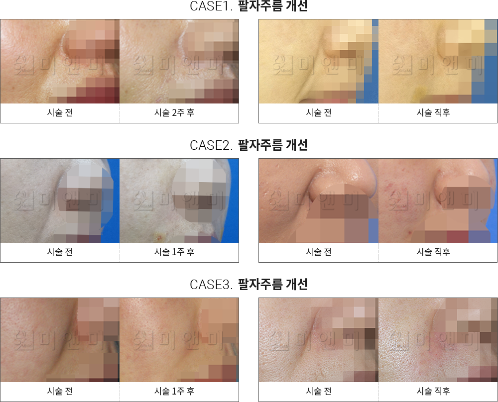 시술전후사진 팔자필러 : 팔자주름 개선 팔자주름필러, 팔자주름필러 효과, 팔자필러