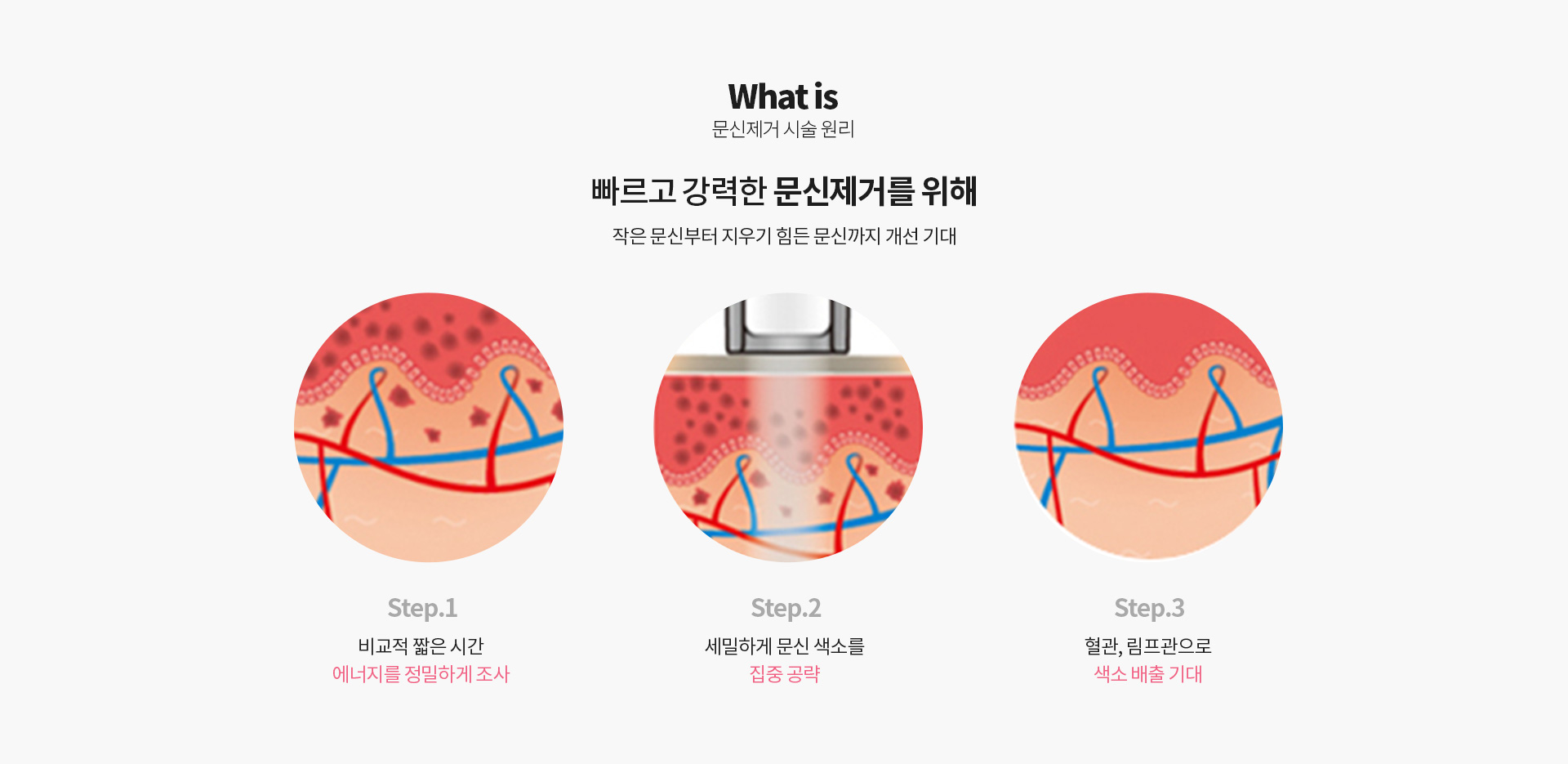 문신제거
