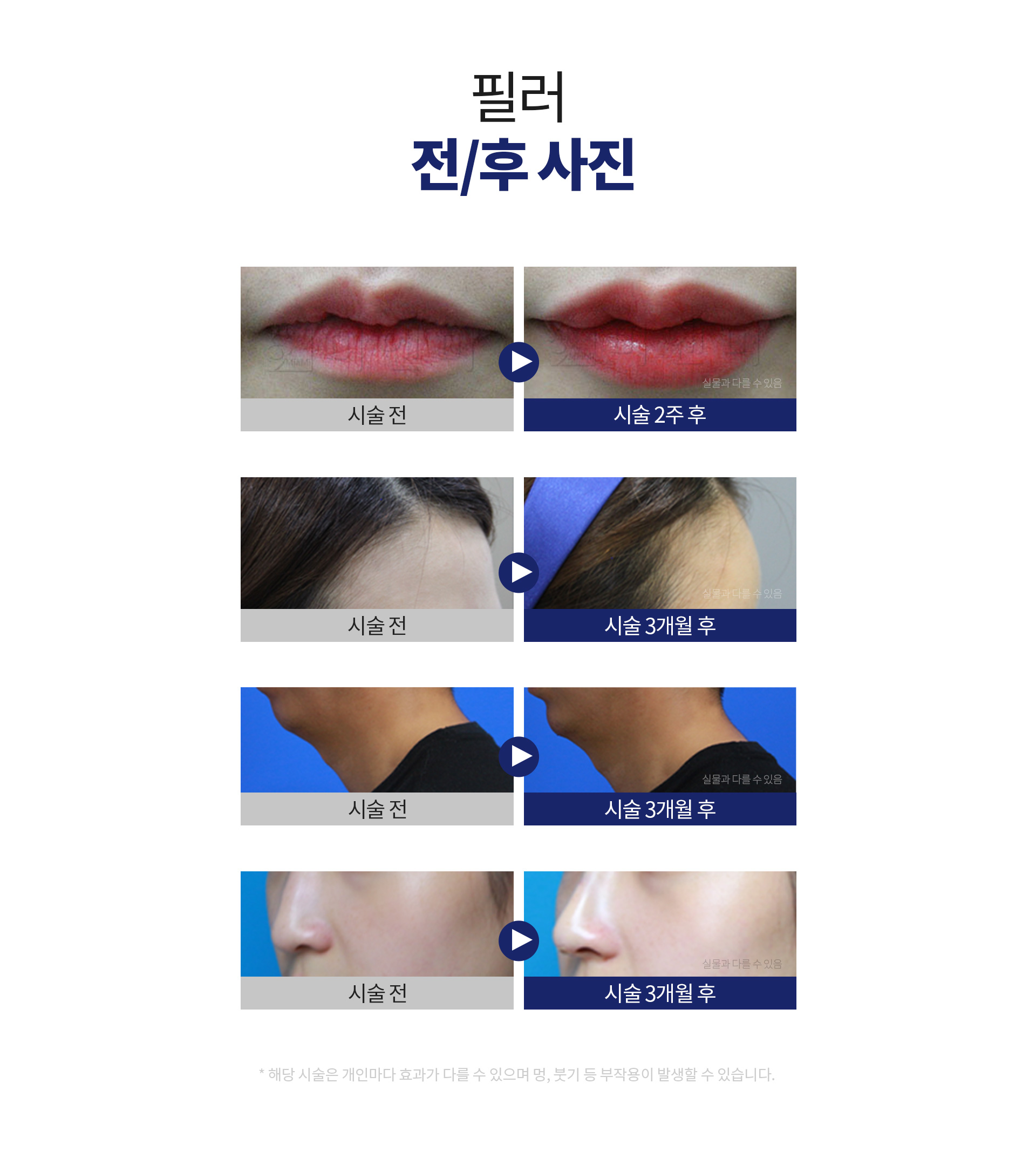 필러