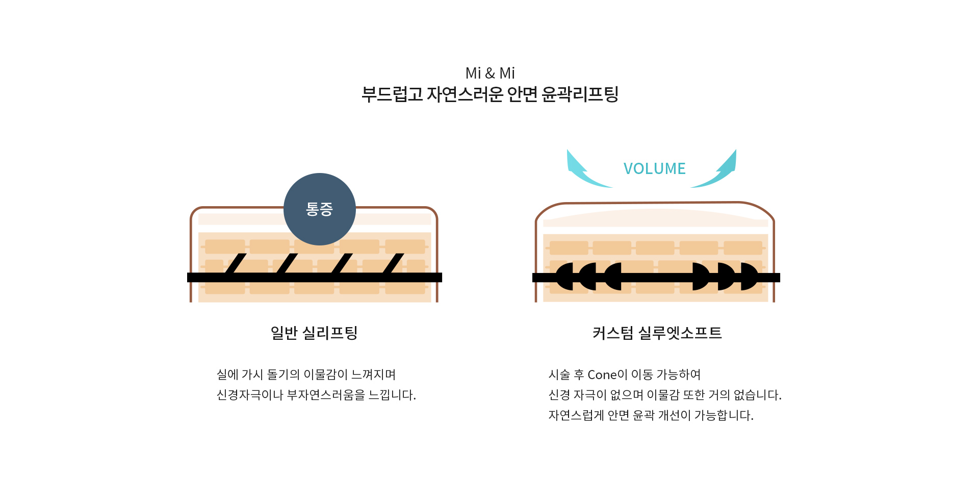 부드럽고 자연스러운 안면 윤곽리프팅 미앤미 실루엣소프트