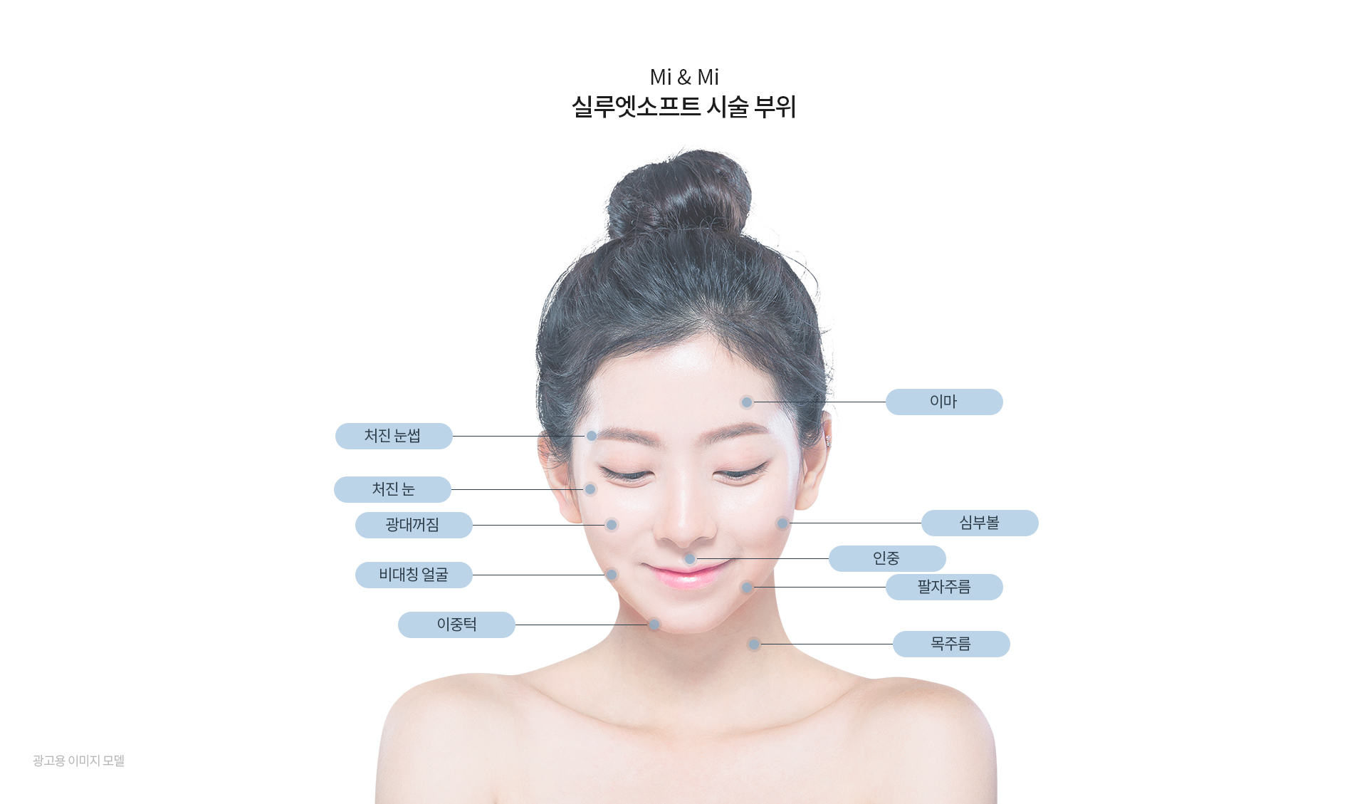 미앤미 실루엣소프트 시술 부위