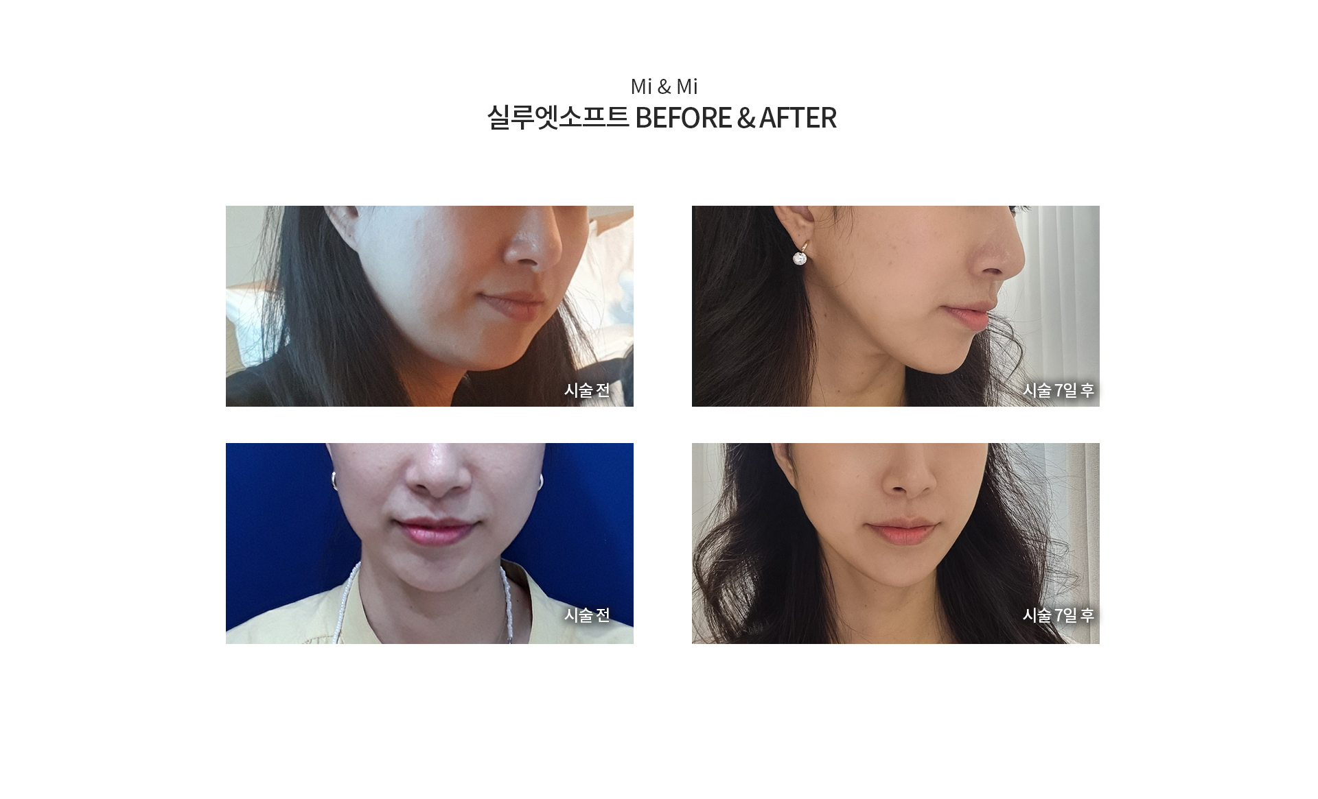 미앤미 실루엣소프트 전후차이