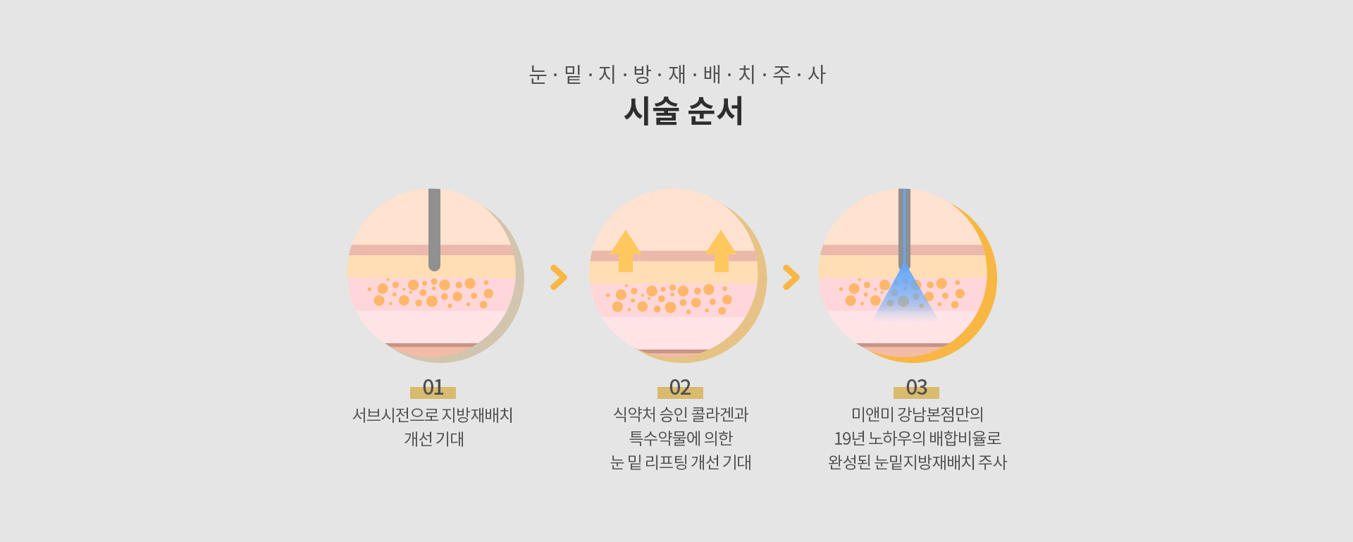 눈밑지방재배치주사 시술순서