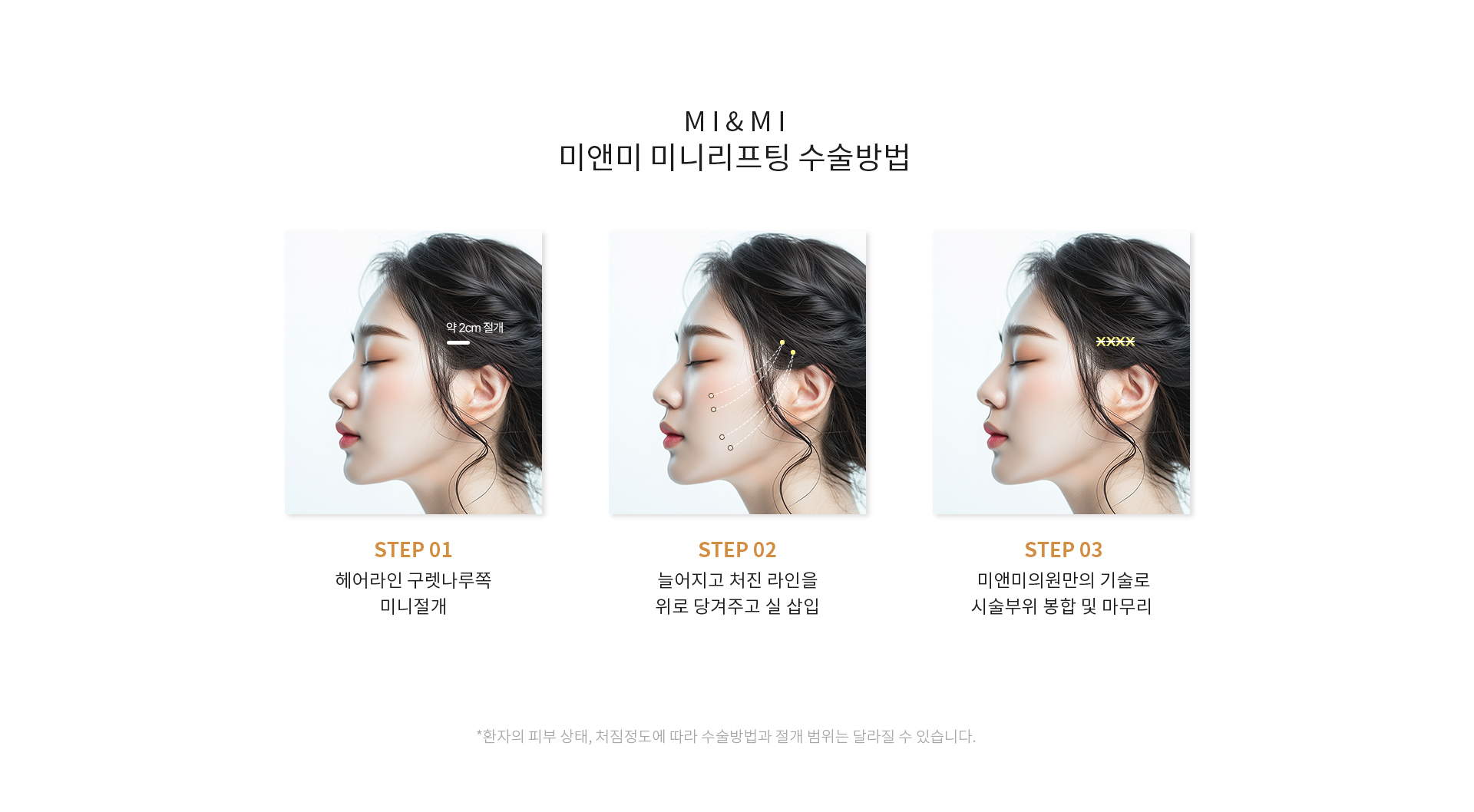 미앤미 초미니리프팅 기대효과