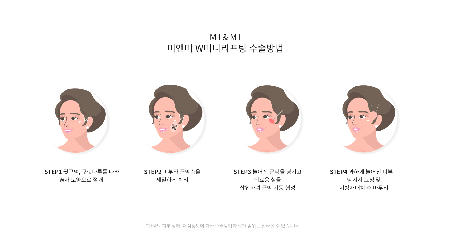 미앤미 W미니리프팅 수술방법