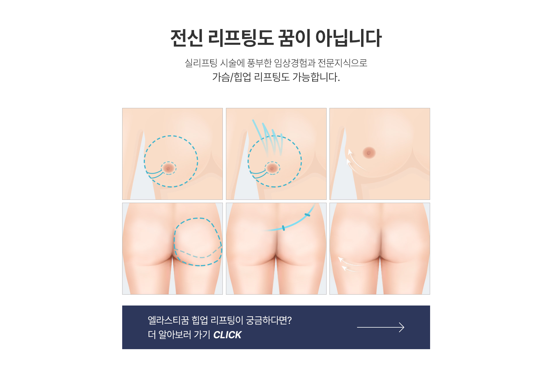 전신리프팅 꿈이 아닙니다 미앤미 엘라스티꿈