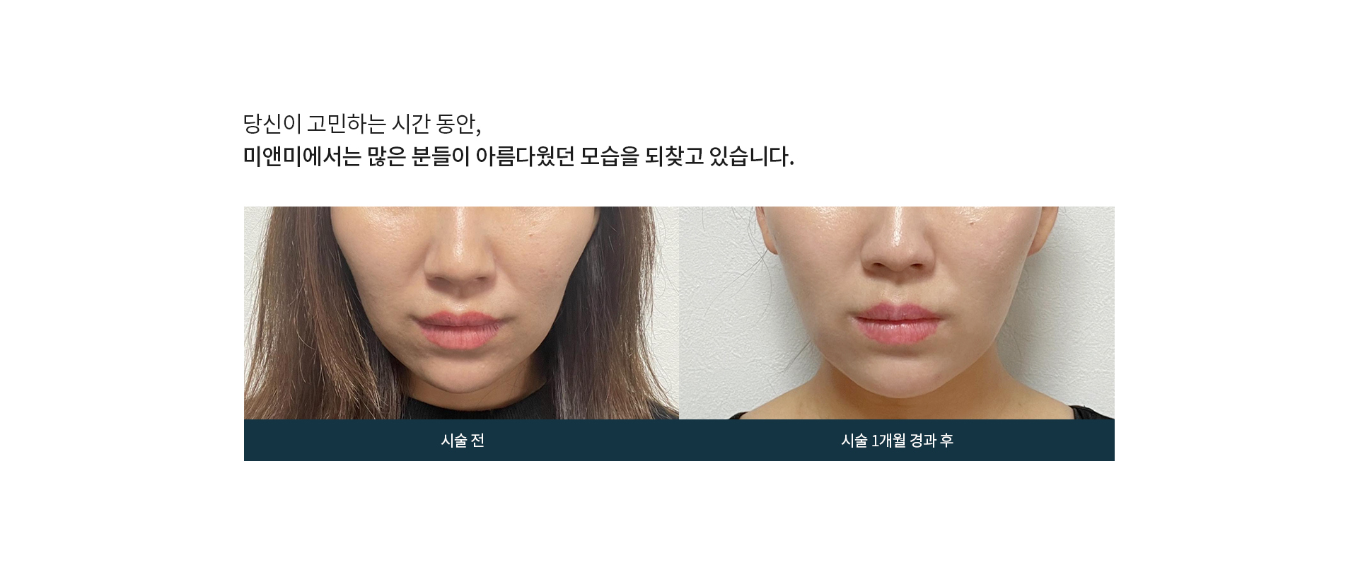 트리플 실리프팅 시술전후