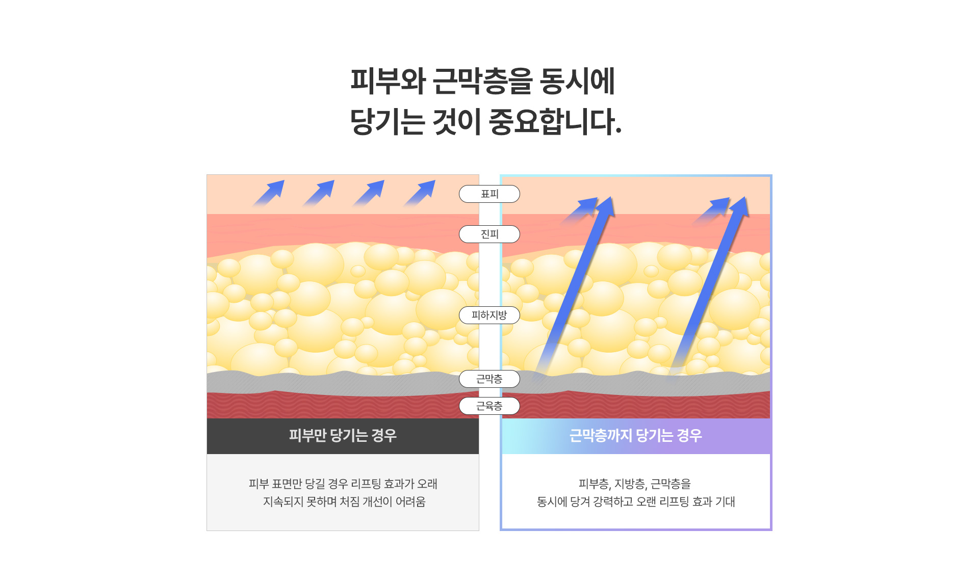 미앤미 풀거상, 피부와 근막층을 동시에 당기는 것이 중요합니다