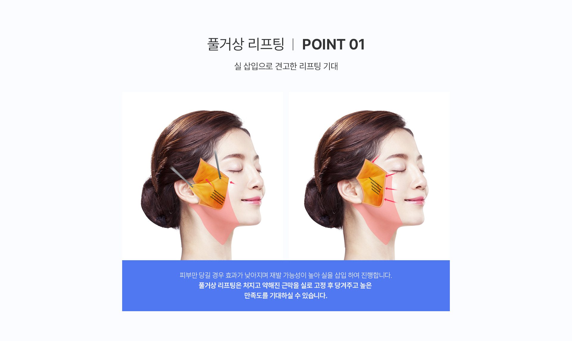 미앤미 풀거상, 실 삽입으로 견고한 리프팅 기대