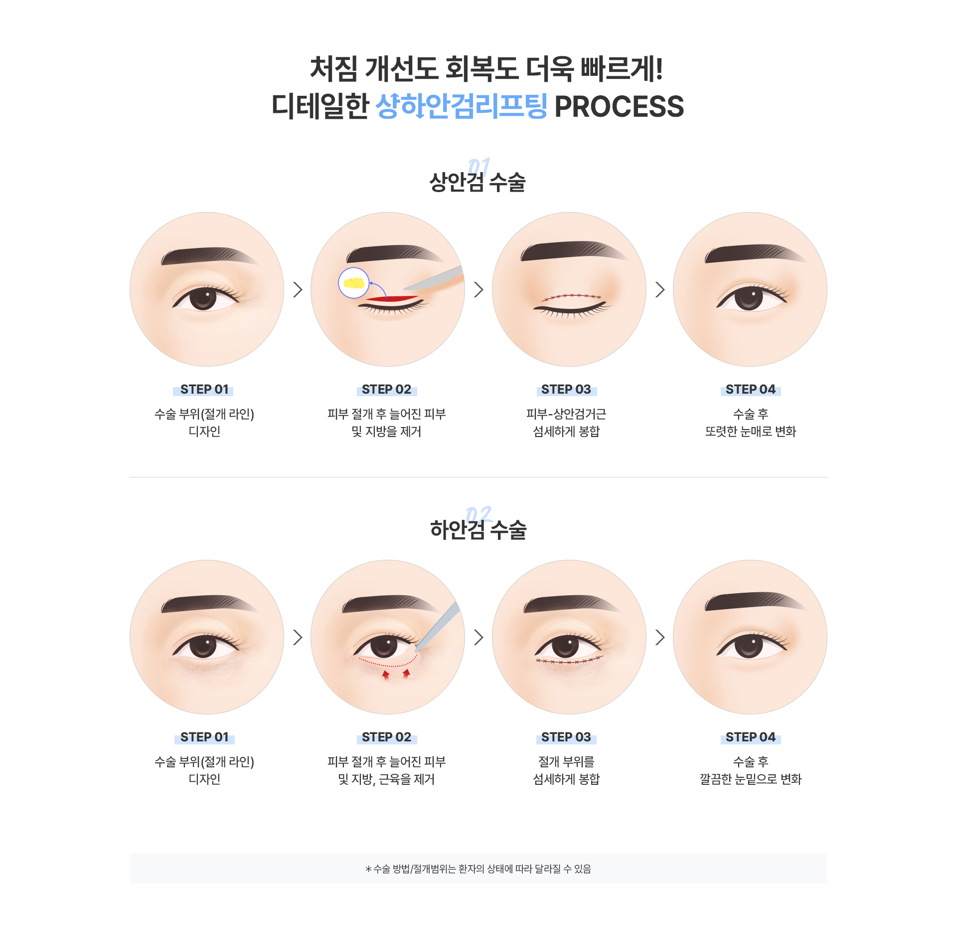 미앤미 상하안검리프팅 후, 어떻게 달라질까요?
