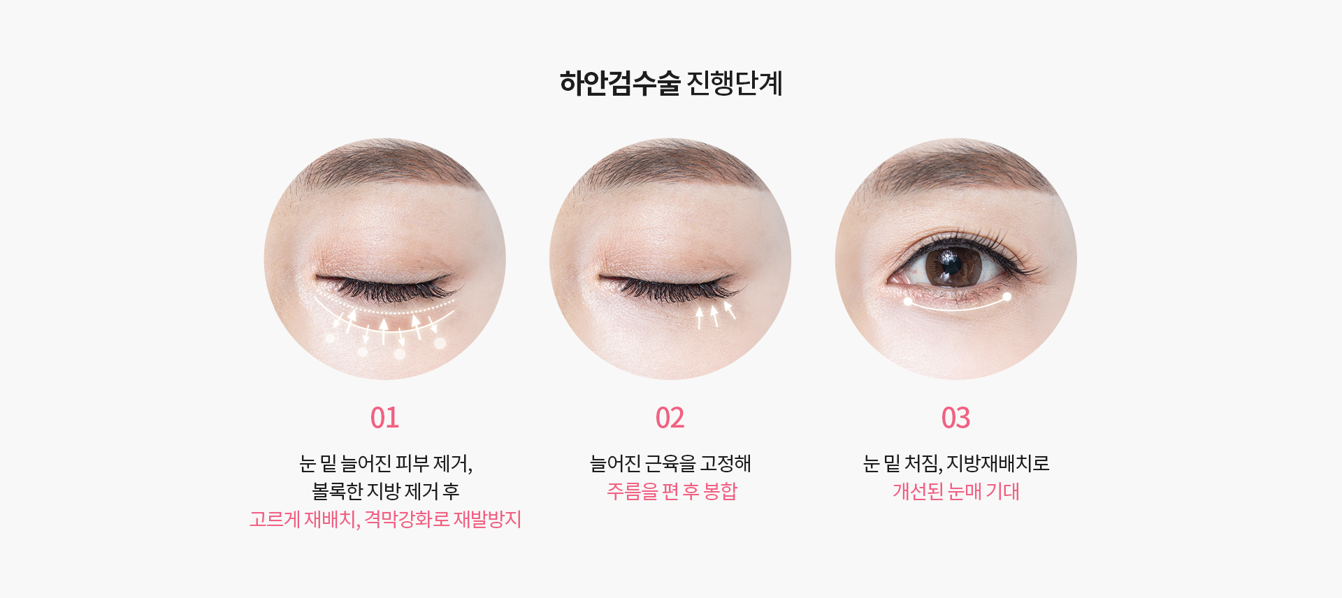 하안검수술 진행단계