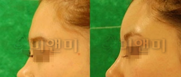 [시술전후사진]코,이마필러시술전후