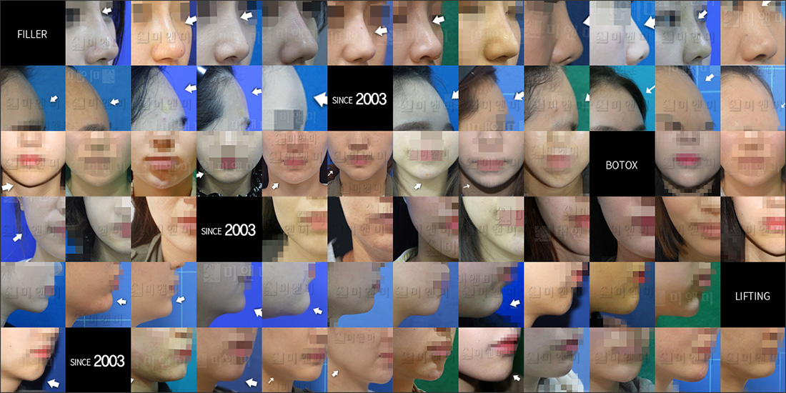 SINCE  2003 MI&MI, 시술후사진모음 미앤미의원, 레이저토닝, 사각턱보톡스, 슈링크, 인모드, 올리지오, 울쎄라, 리쥬란힐러