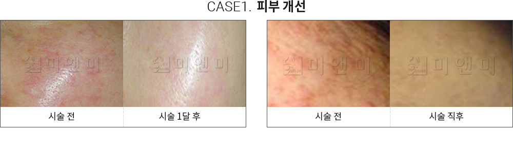 시술전후사진 : 미앤미의원, 레이저토닝, 사각턱보톡스, 슈링크, 인모드, 올리지오, 울쎄라, 리쥬란힐러