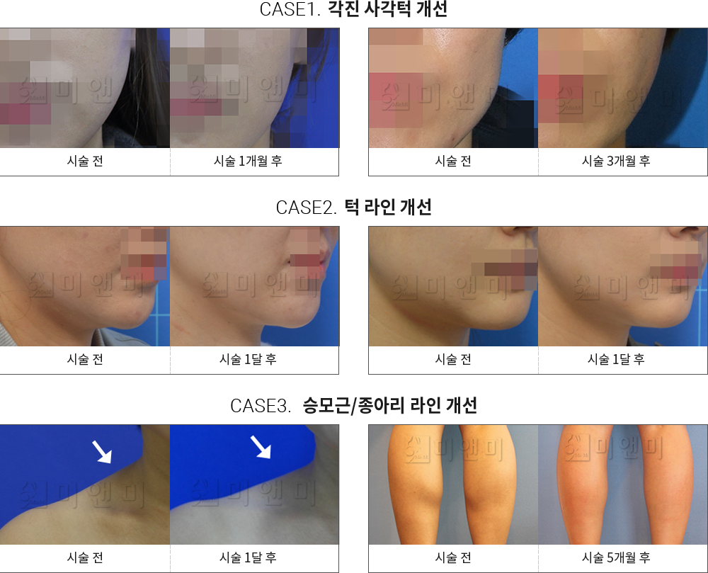 시술전후사진 승모근 보톡스 : 각진 사각턱 개선,턱 라인 개선,승모근/종아리 라인 개선 승모근보톡스 - 미앤미 의원