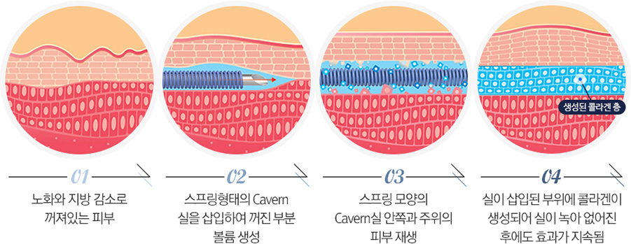 강남 캐번리프팅, 강남역 캐번리프팅