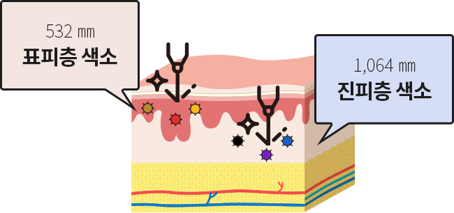 532㎜ 표피층 색소 / 1,064㎜ 진피층 색소