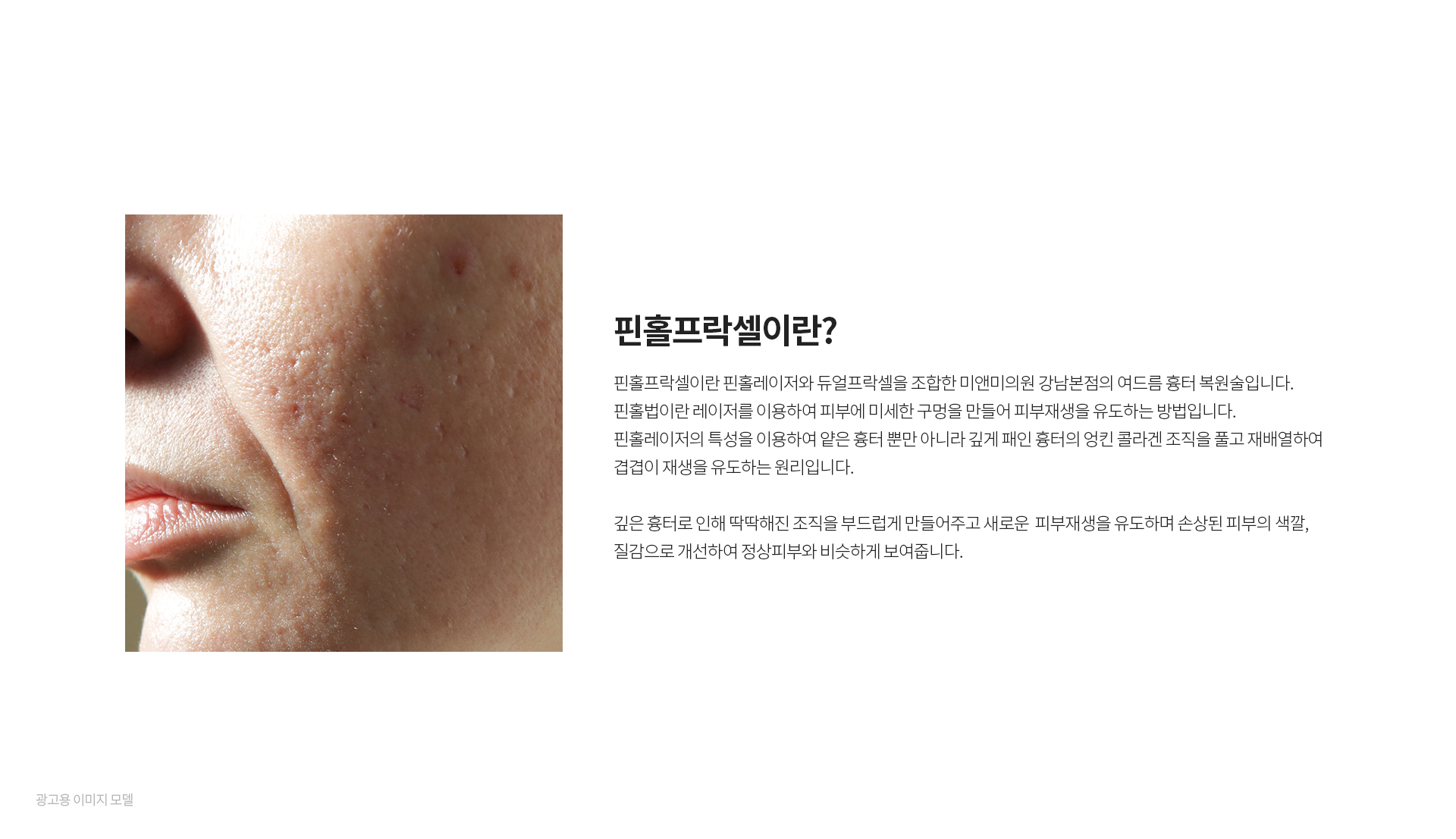 미앤미 핀홀프락셀이란?