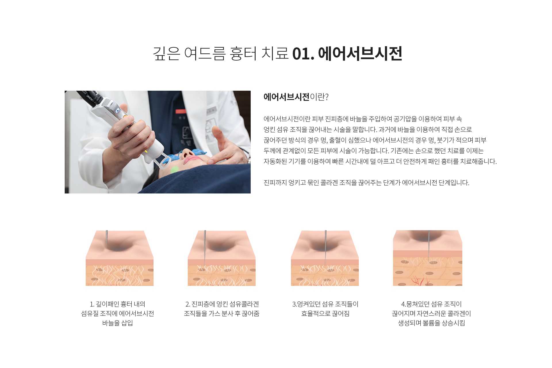 깊은 여드름 흉터 치료 01. 에어서브시전