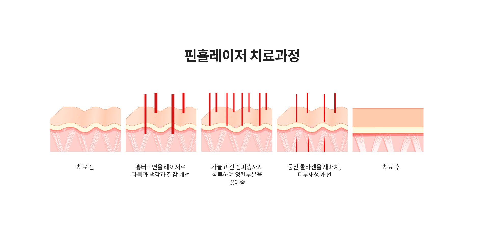 핀홀프락셀 치료과정