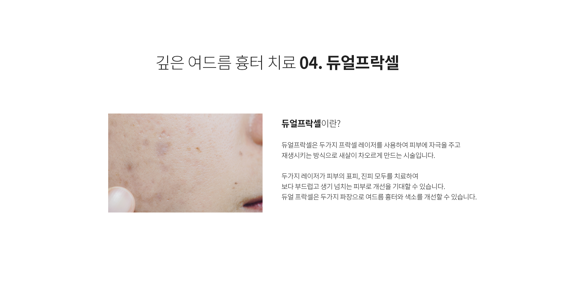 깊은 여드름 흉터 치료 04. 듀얼프락셀