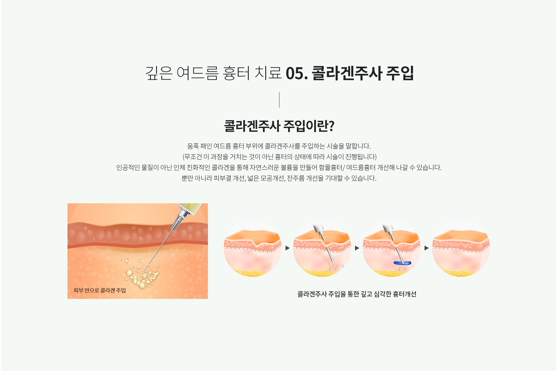 깊은 여드름 흉터 치료 05.콜라겐주사 주입