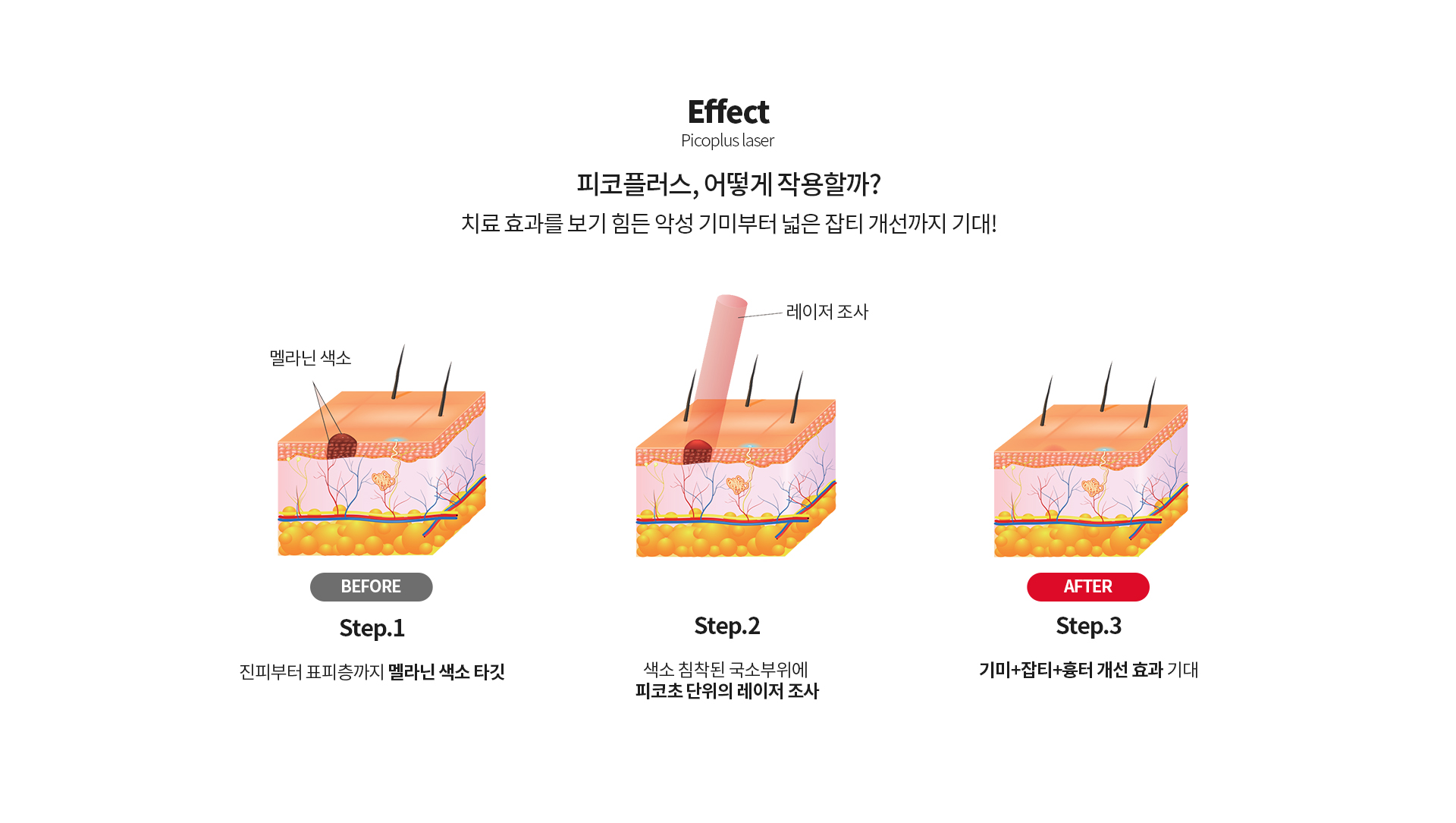 피코플러스 치료효과를 보기 힘든 악성 기미부터 넓은 잡티 개선까지 기대!