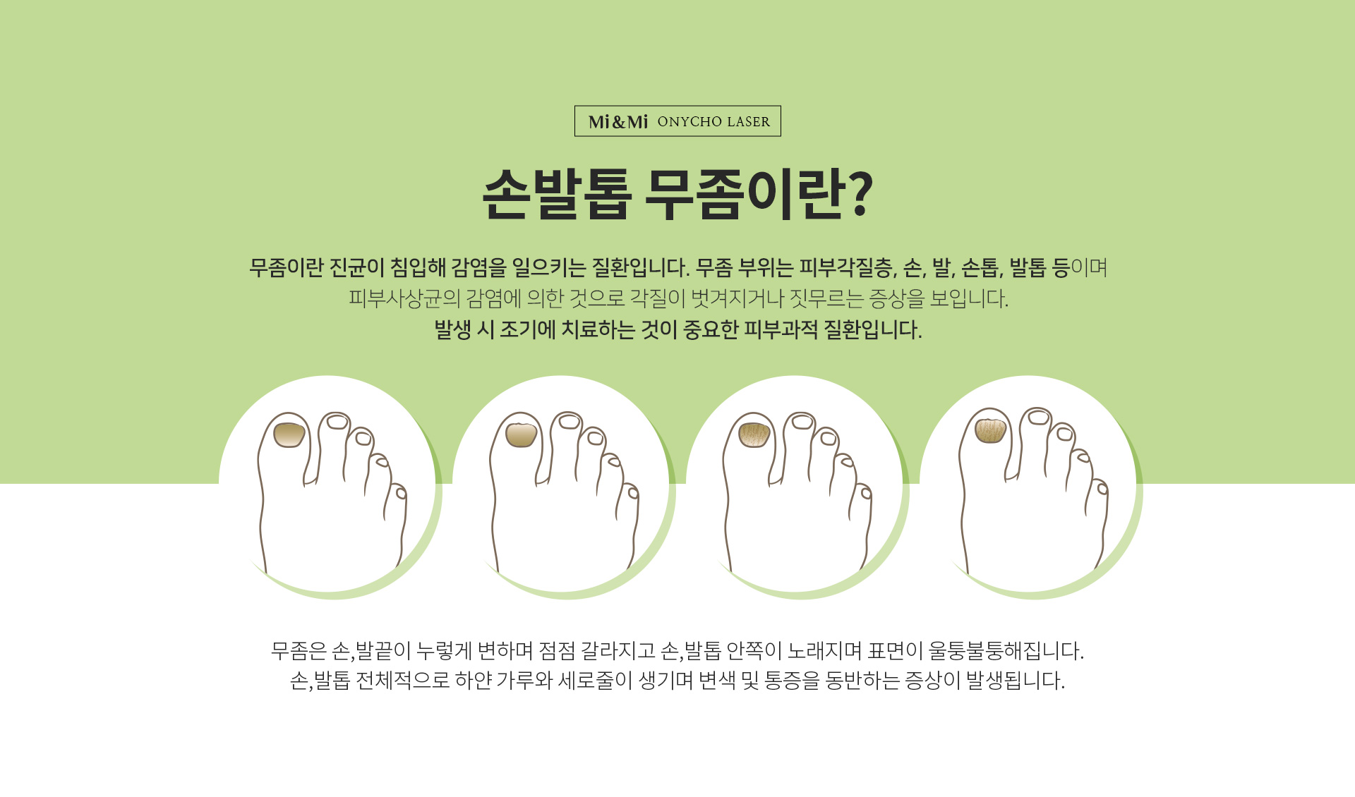 손발톱 무좀이란?