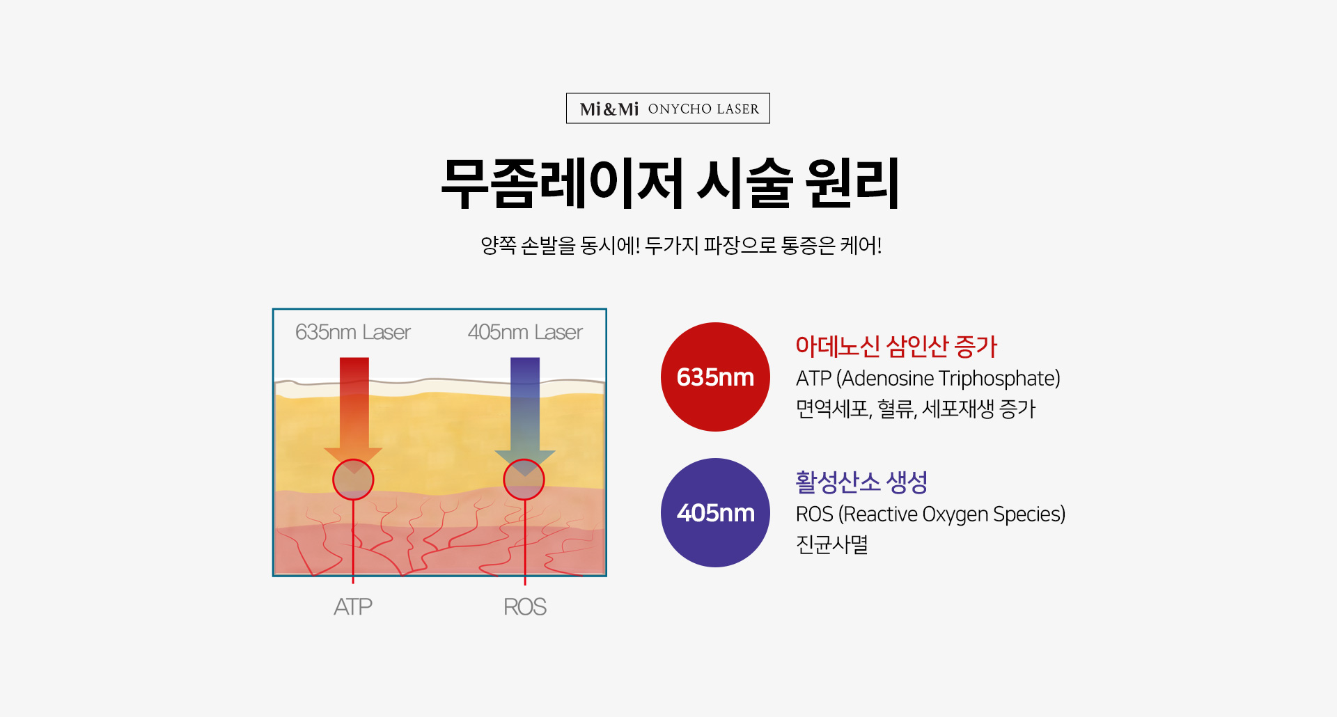 무좀레이저 시술 원리