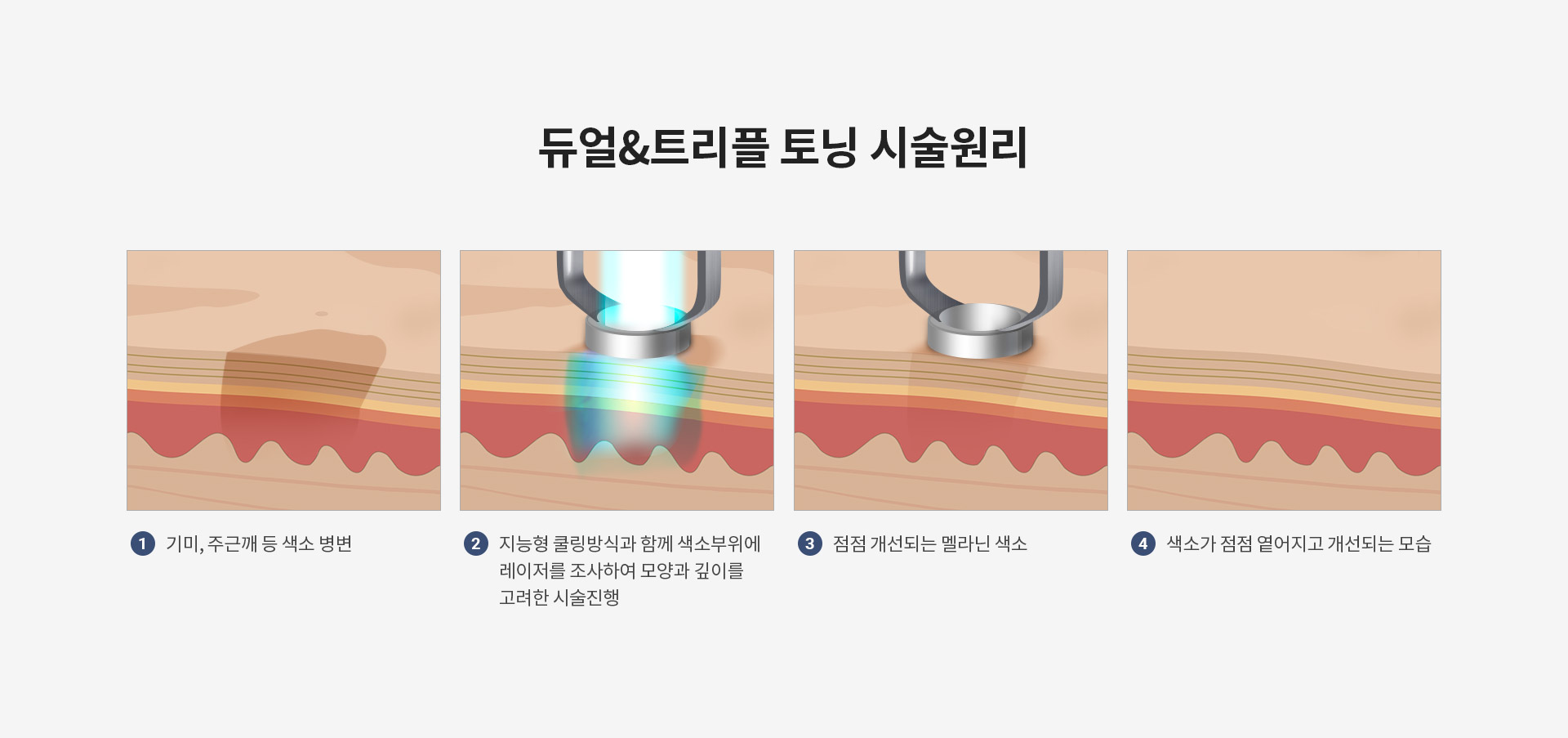 듀얼트리플토닝 듀얼&트리플 토닝 시술원리