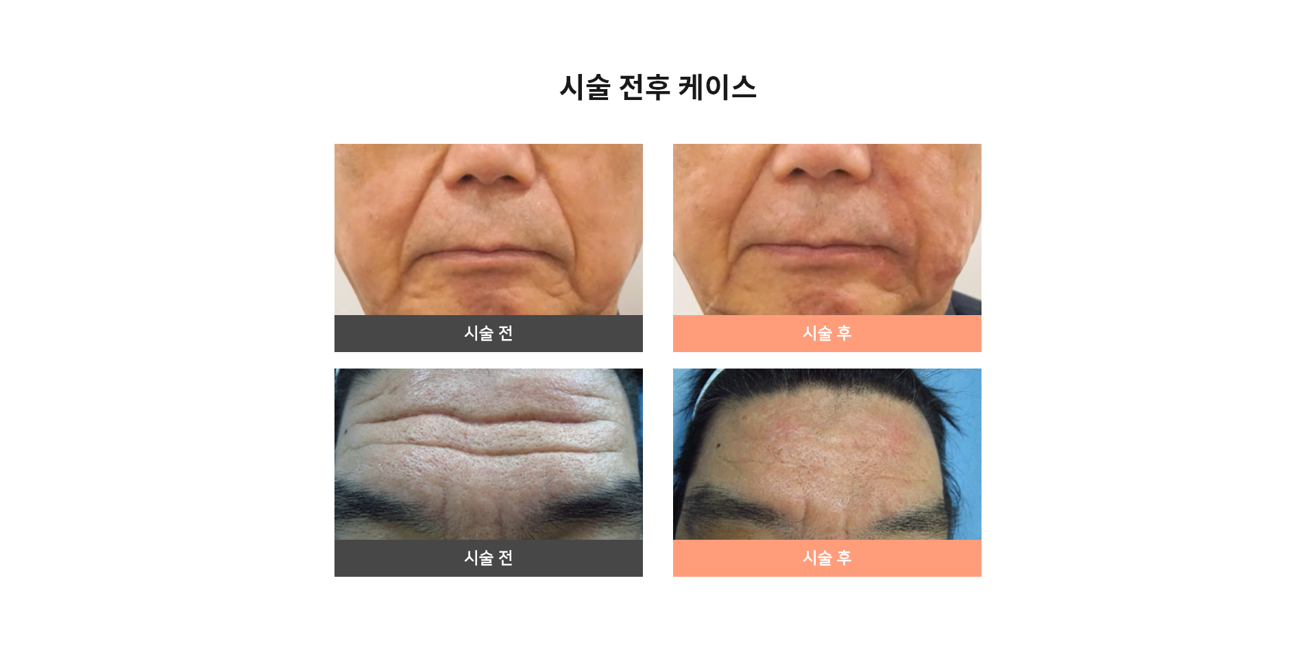 시술 전후 케이스