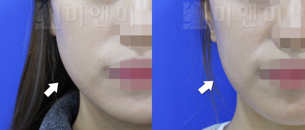 사각턱보톡스 시술전후