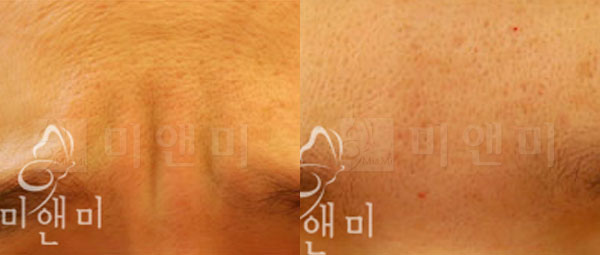 [시술전후사진] 미간주름 필러시술전후