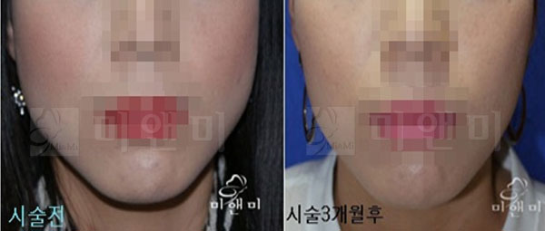 [시술전후사진]사각턱보톡스 시술전후