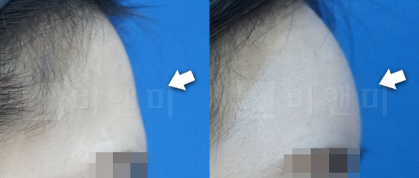 이마필러 전후