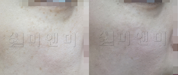 토닝레이저+백옥주사+신데렐라 주사 시술 전후
