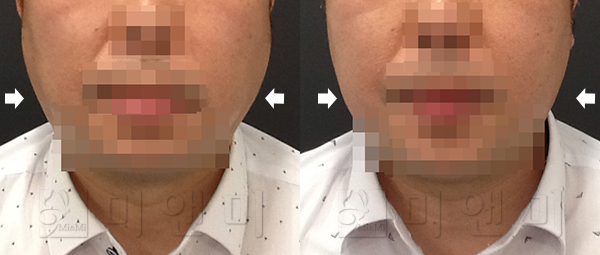 턱보톡스 시술전후