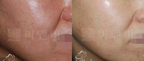 [시술전후사진]기미,홍조치료-IPL+레이저토닝 시술전후 사진