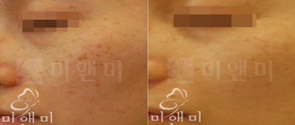 [시술전후사진]기미치료 레이저토닝 시술전후사진