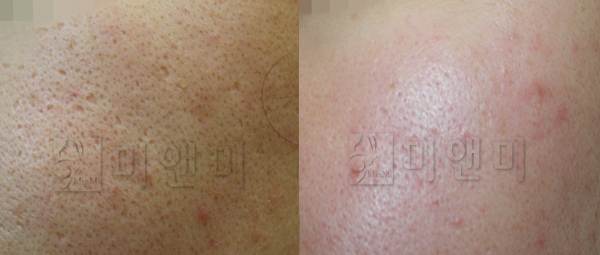 [시술전후사진]여드름흉터 시술전후