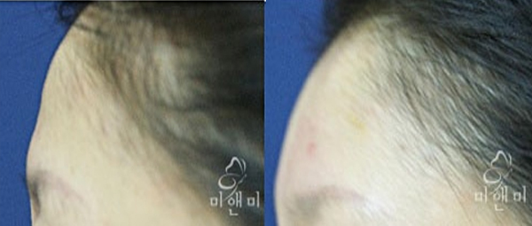 [시술전후사진]이마필러 시술전후