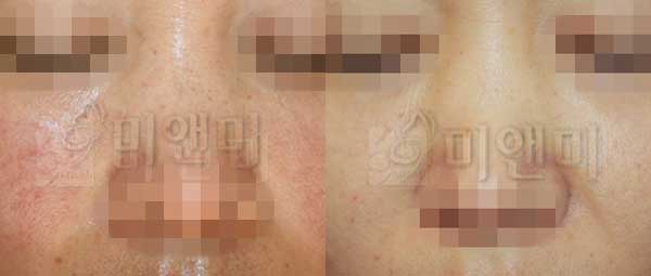 미백관리_ IPL전후사진