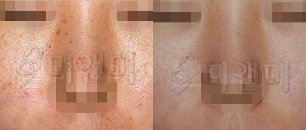 [시술전후사진]주근깨/잡티치료 IPL전후