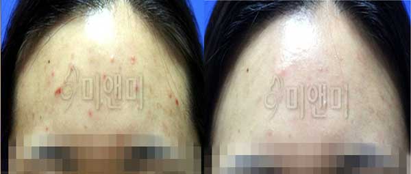 [시술전후사진]여드름 시술 전후